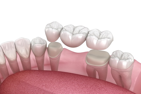 Getting A Dental Bridge With Your Supporting Teeth