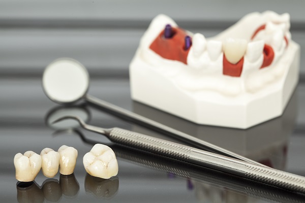 When Is A Dental Crown Necessary?