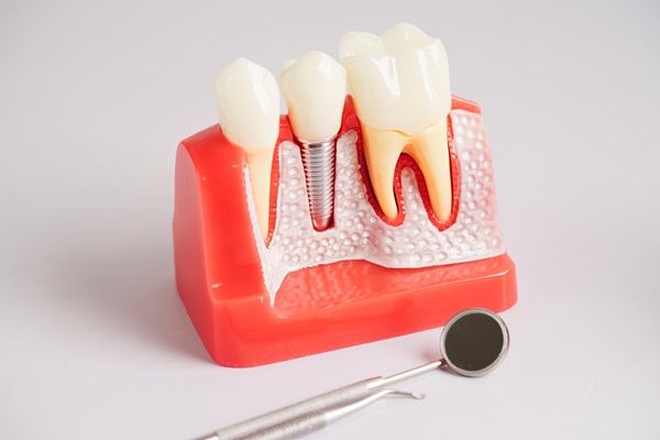 What Is Dental Implant Restoration?